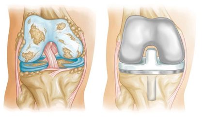 Total Knee Replacement
